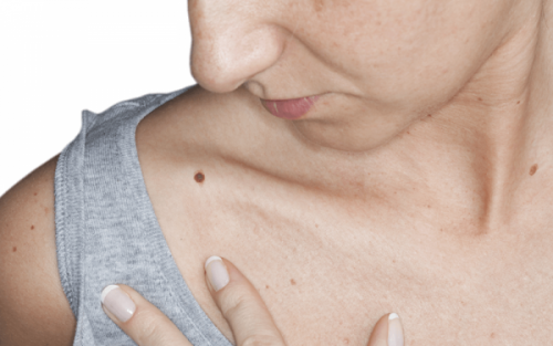 Mole Removal: What to Know Before You Visit a ...
