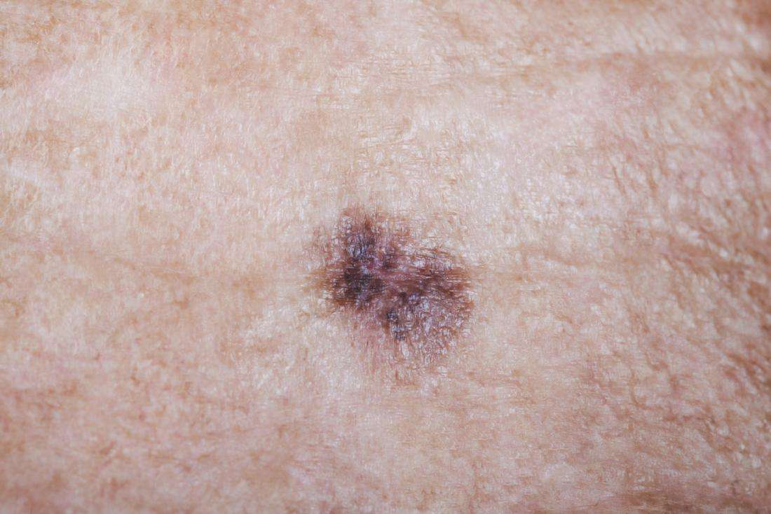 Most melanomas grow as new spots, not from existing moles