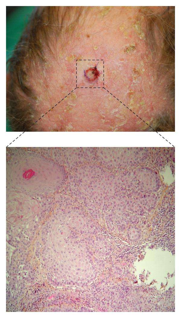 Multifocal Aggressive Squamous Cell Carcinomas Induced by ...
