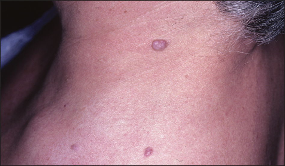 Multiple Eruptive Angiomatous Lesions in a Patient With Multiple ...