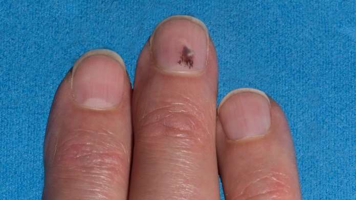 *Must Read* Top 5 Dangerous Nail Melanoma Stages