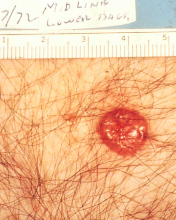 My Basal Cell CarcinomaThe " Good"  Skin Cancer