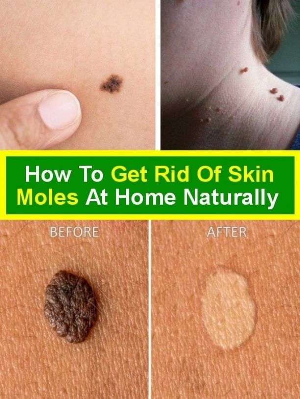 Naturally, at home you can get rid of Skin Moles.