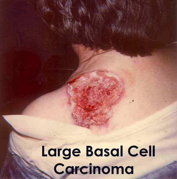 Neglected Basal Cell Skin Cancer