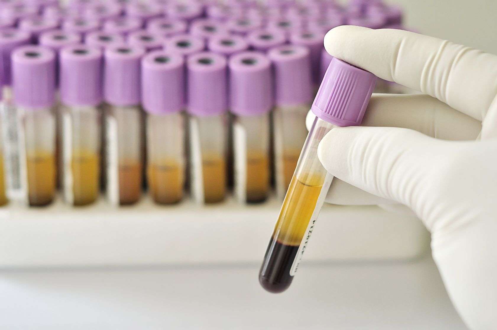 New blood test can " differentiate between pancreatic ...
