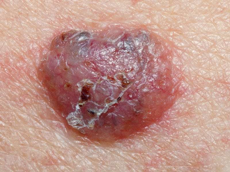 New Drug Treatments for Basal Cell Carcinoma