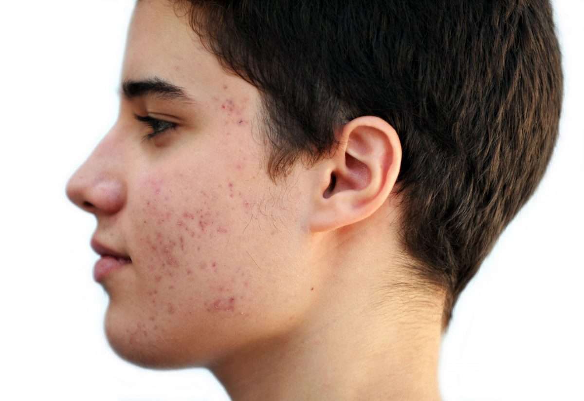 New treatment for oily skin? Low dose accutane that was the only thing ...