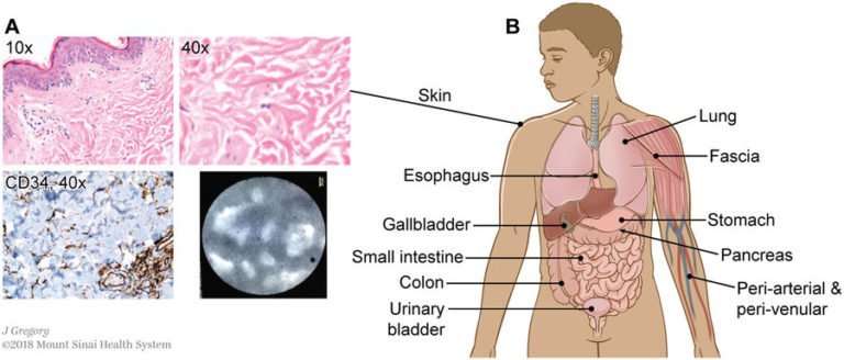 Newly discovered body organ may explain how cancer spreads ...