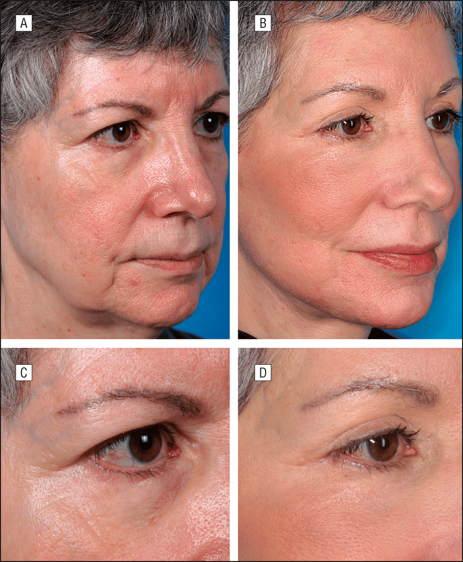 Nitrogen Plasma Skin Regeneration and Aesthetic Facial Surgery ...