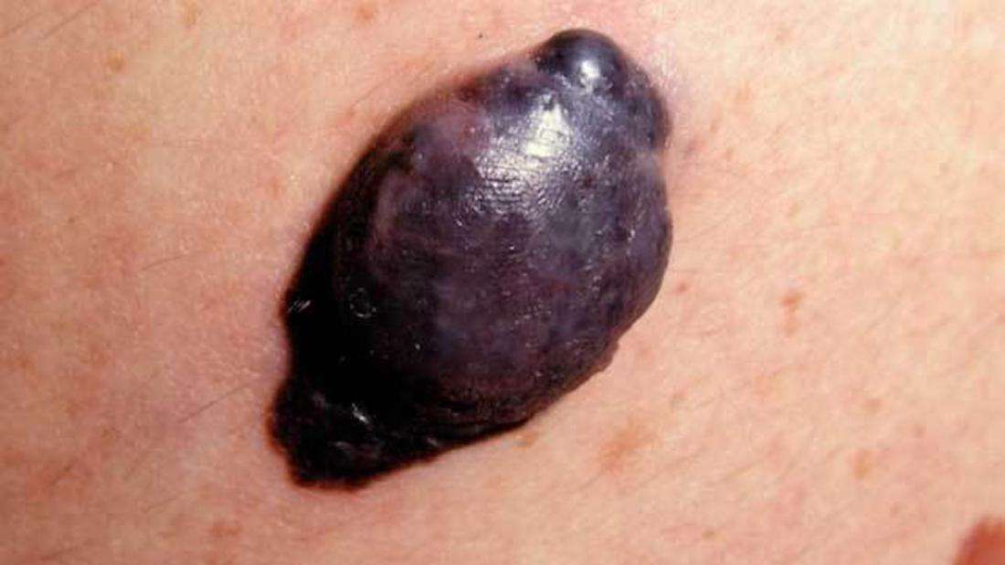 Nodular melanoma: Symptoms, risk factors, diagnosis, and ...