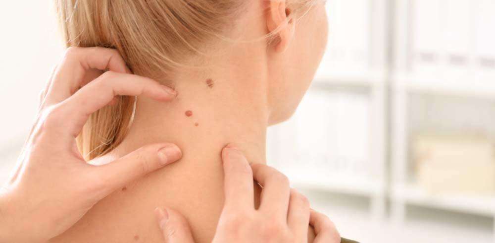 Normal mole or skin cancer: How to tell the difference ...