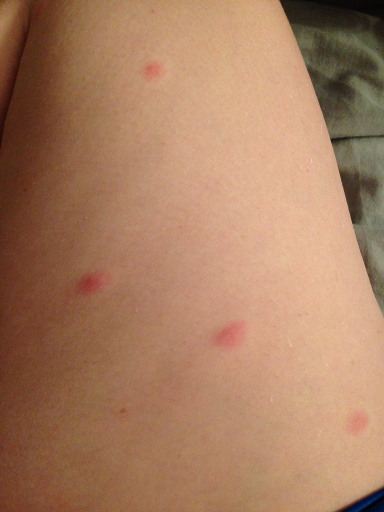 Noticed a few small itchy bumps on my thighs late last night, woke up ...