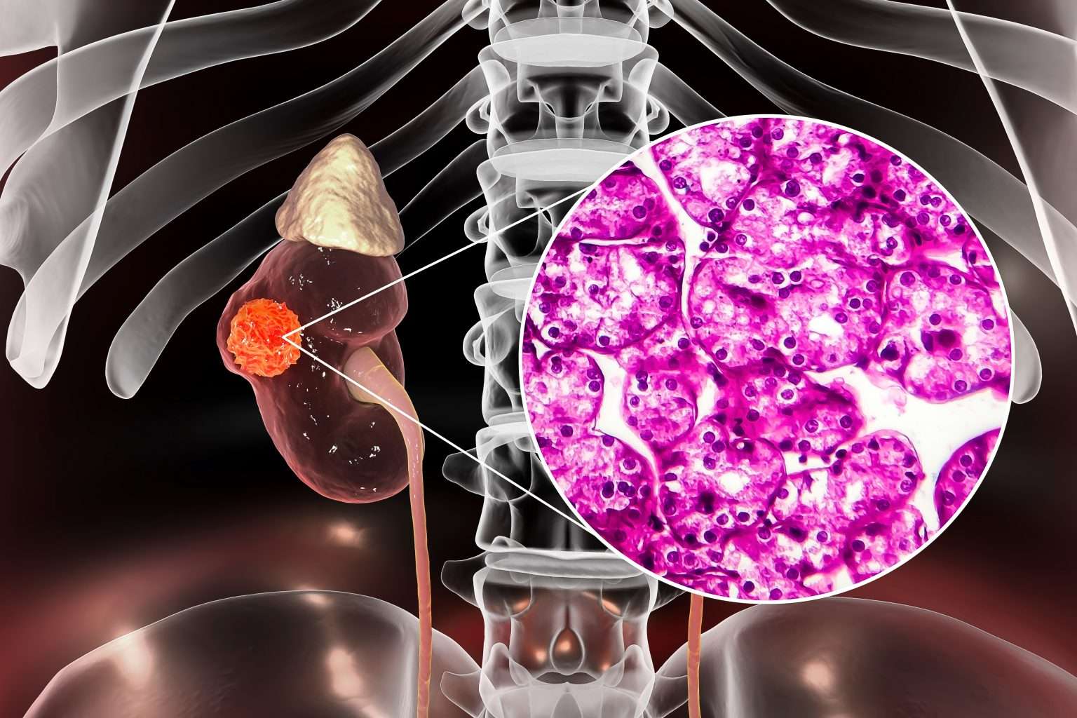 Novel target could improve treatments for renal cell carcinoma