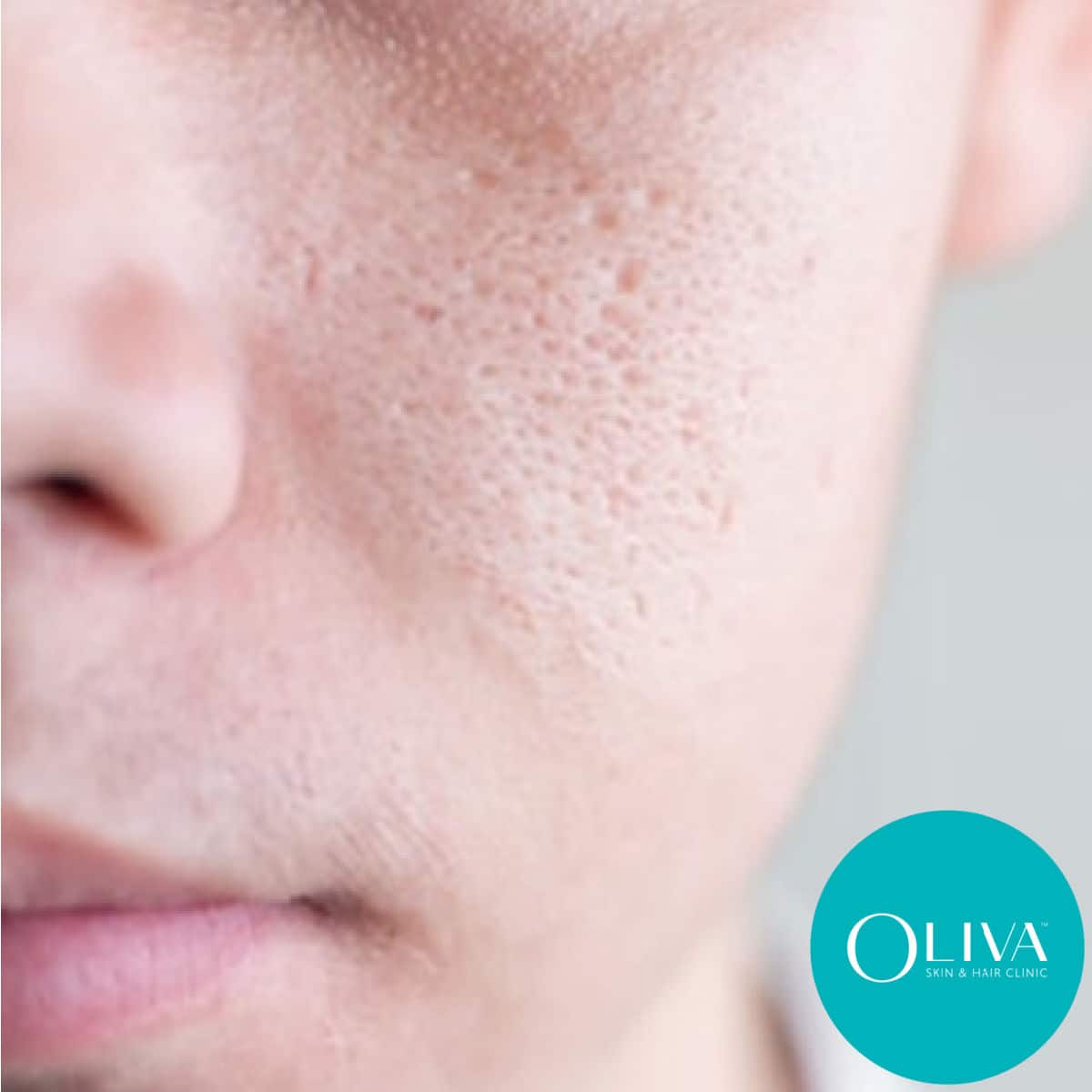 Open Pores: Causes, Diagnosis, Treatment And Results