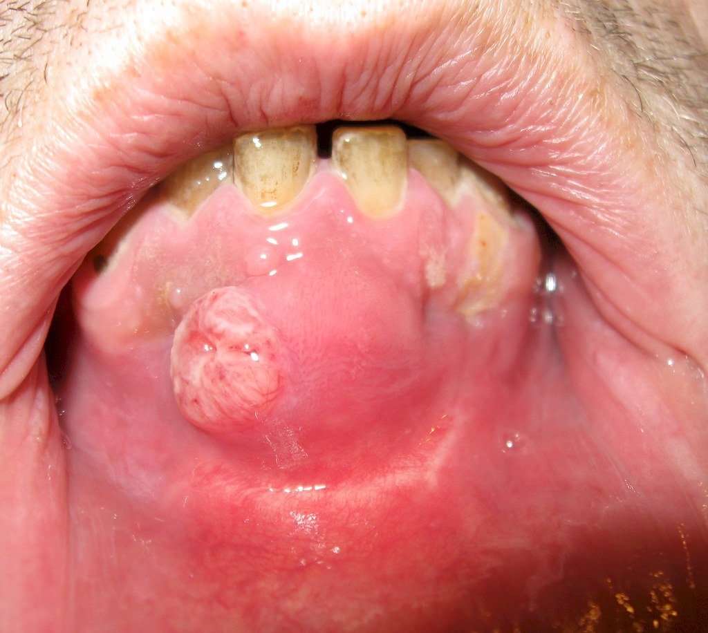 oral carcinoma / mouth cancer