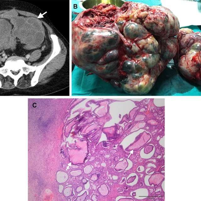 Ovarian metastasis from colon cancer. A Axial CT of a 62 ...