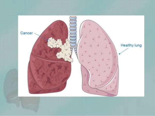 Overview about lung cancer spreads other parts of the body