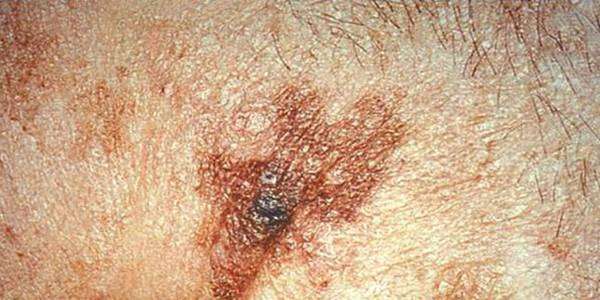 Pain and itch associated with histologic features of skin cancers