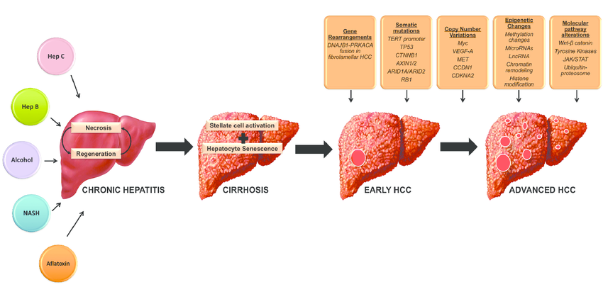 Pathogenesis of Hepatocellular Carcinoma. Chronic exposure of the liver ...