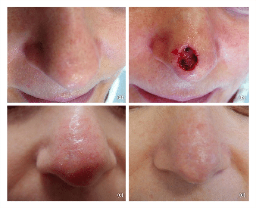 Patient #5: (a) Basal cell carcinoma of the nasal tip. (b ...