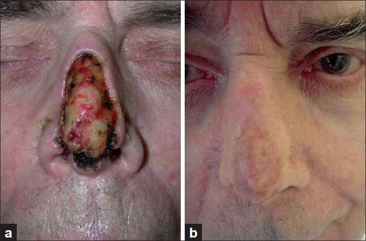 Patient 7. (a) After Mohs surgery of basal cell carcinoma ...