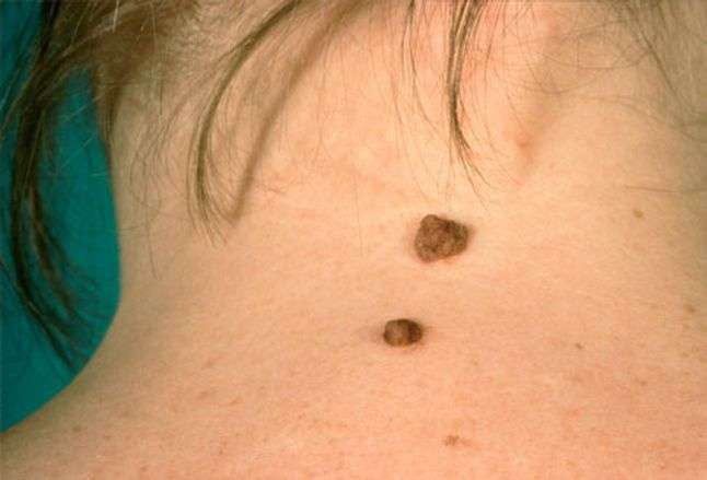Picture of Moles