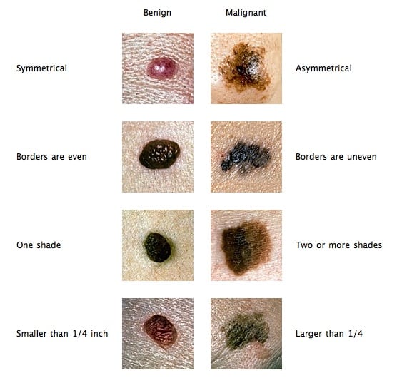 Pictures of Skin Cancer