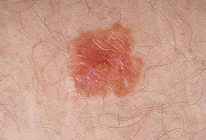 Pictures of skin cancer: Non melanoma skin cancer