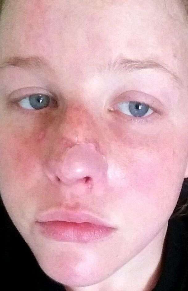 Pictures Of Skin Cancer On Face Nose