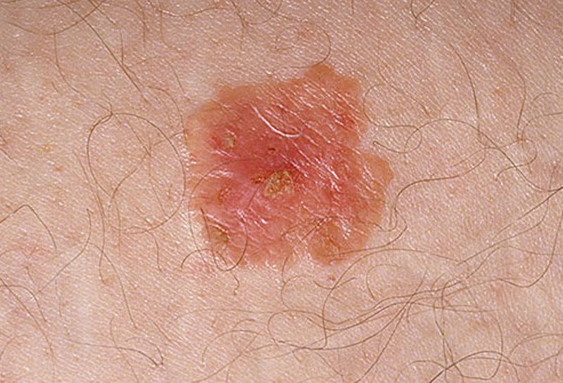Pictures of skin cancer: Skin cancer types pictures