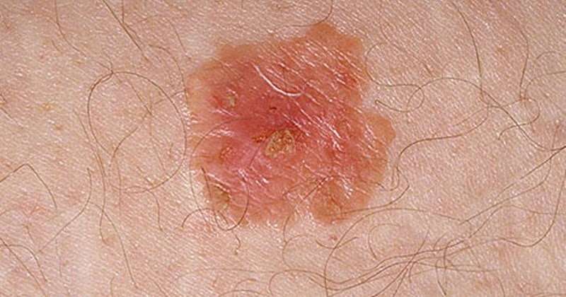 Pictures of skin cancer: Skin cancer white spots