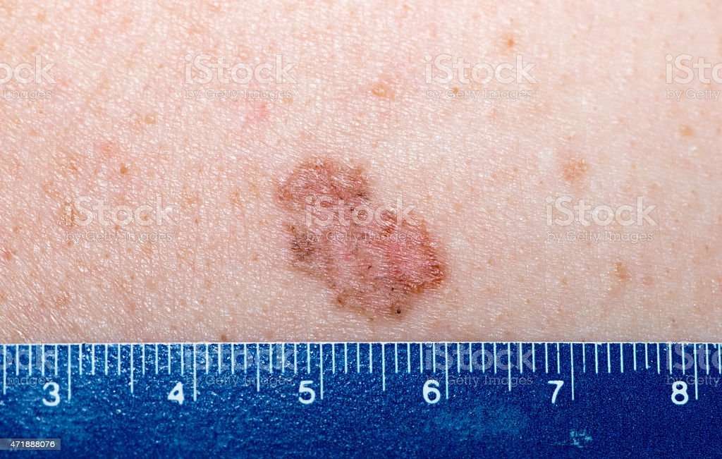 Pigmented Superficial Type Basal Cell Carcinoma Stock ...