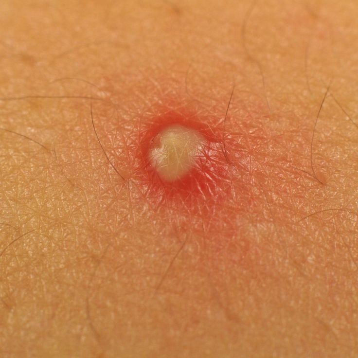 Pin on Common Skin Disorders and Diseases