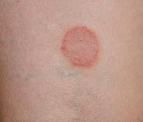 Pin on Skin rashes pictures