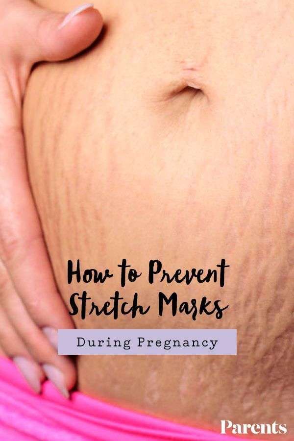 Pin on Stretch Marks