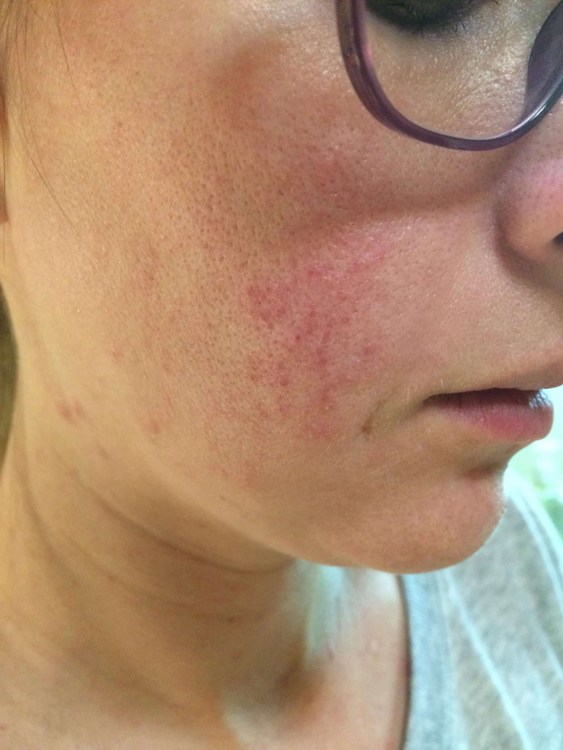 Please help us identify this skin condition. : SkincareAddicts