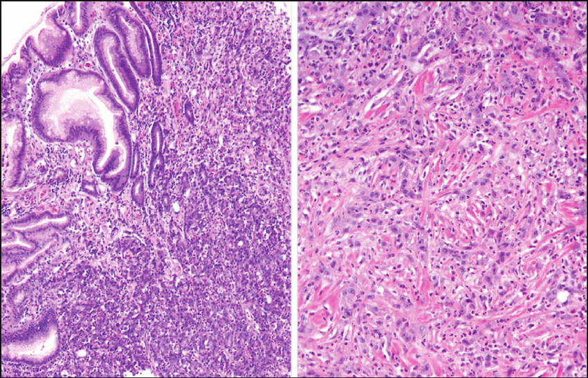 Poorly differentiated gastric adenocarcinoma.