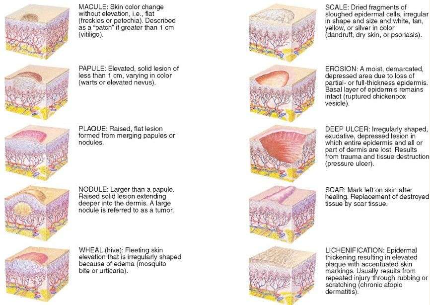 Primary and Secondary Lesions