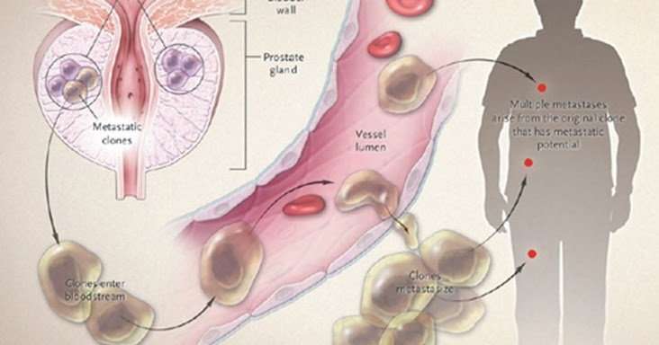 Prostate Cancer Spread Metastatic To Bones Life Expectancy