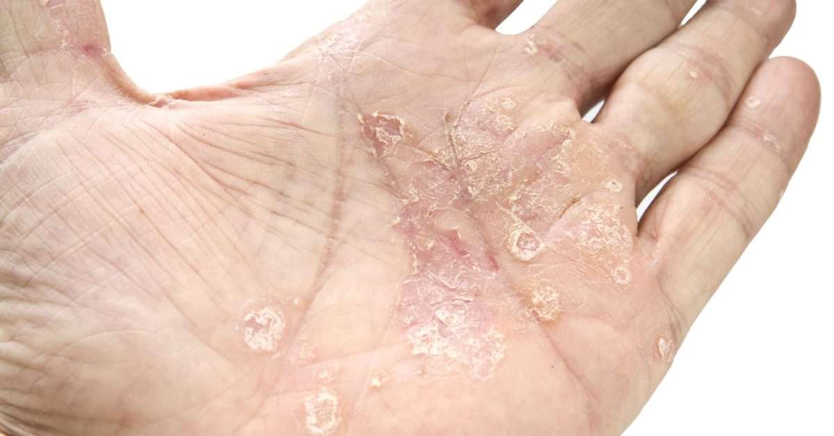 Psoriasis and cancer: Is there a link?