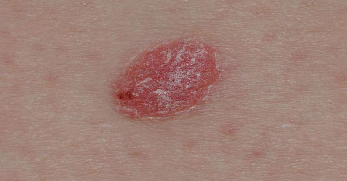 Psoriasis or skin cancer? How to tell the difference