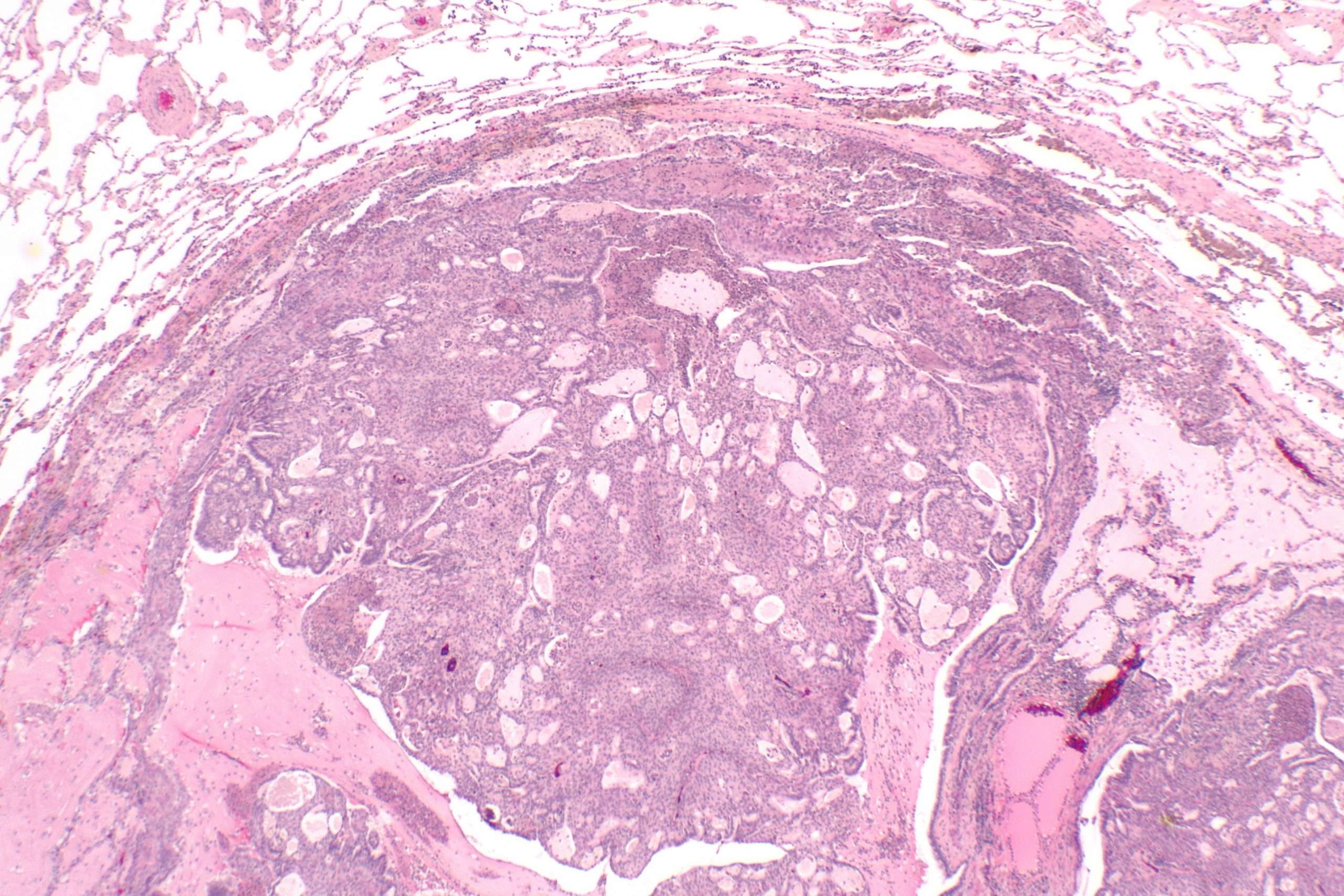 Pulmonary Mixed Squamous Cell and Glandular Papilloma