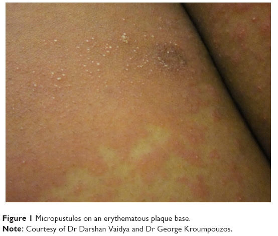 Pustular psoriasis of pregnancy: current perspectives