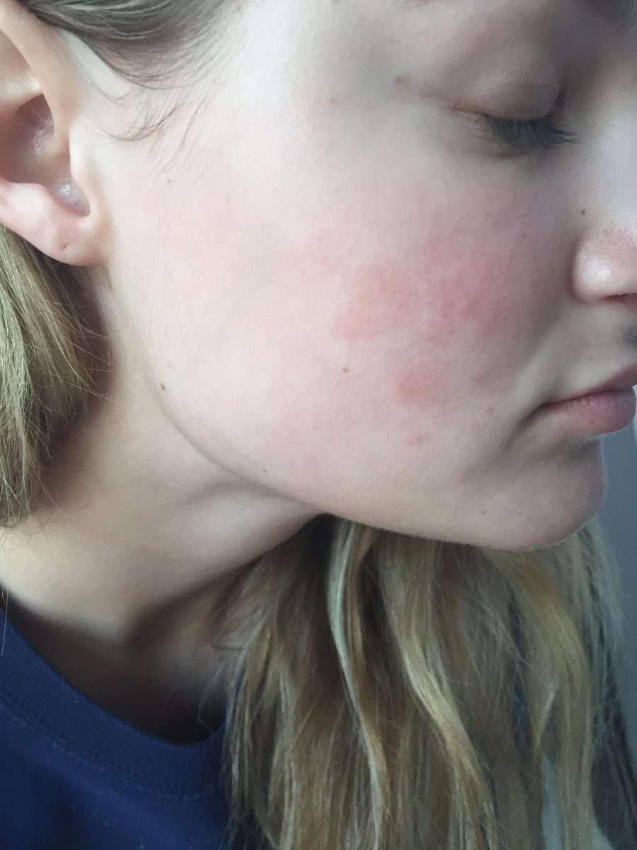 Random red patches on face??