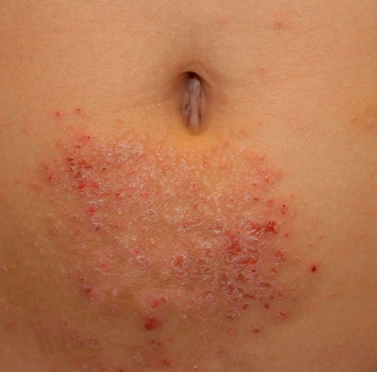 Rash on Stomach Causes, Pictures and Back, Breast, Groin, Belly Button ...