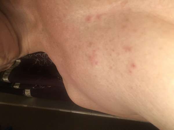 Rash on top of one breast. How do I get my doctor to do a ...