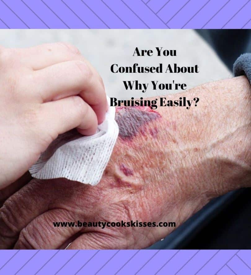 Reasons for Bruising Too Easily You Should Know