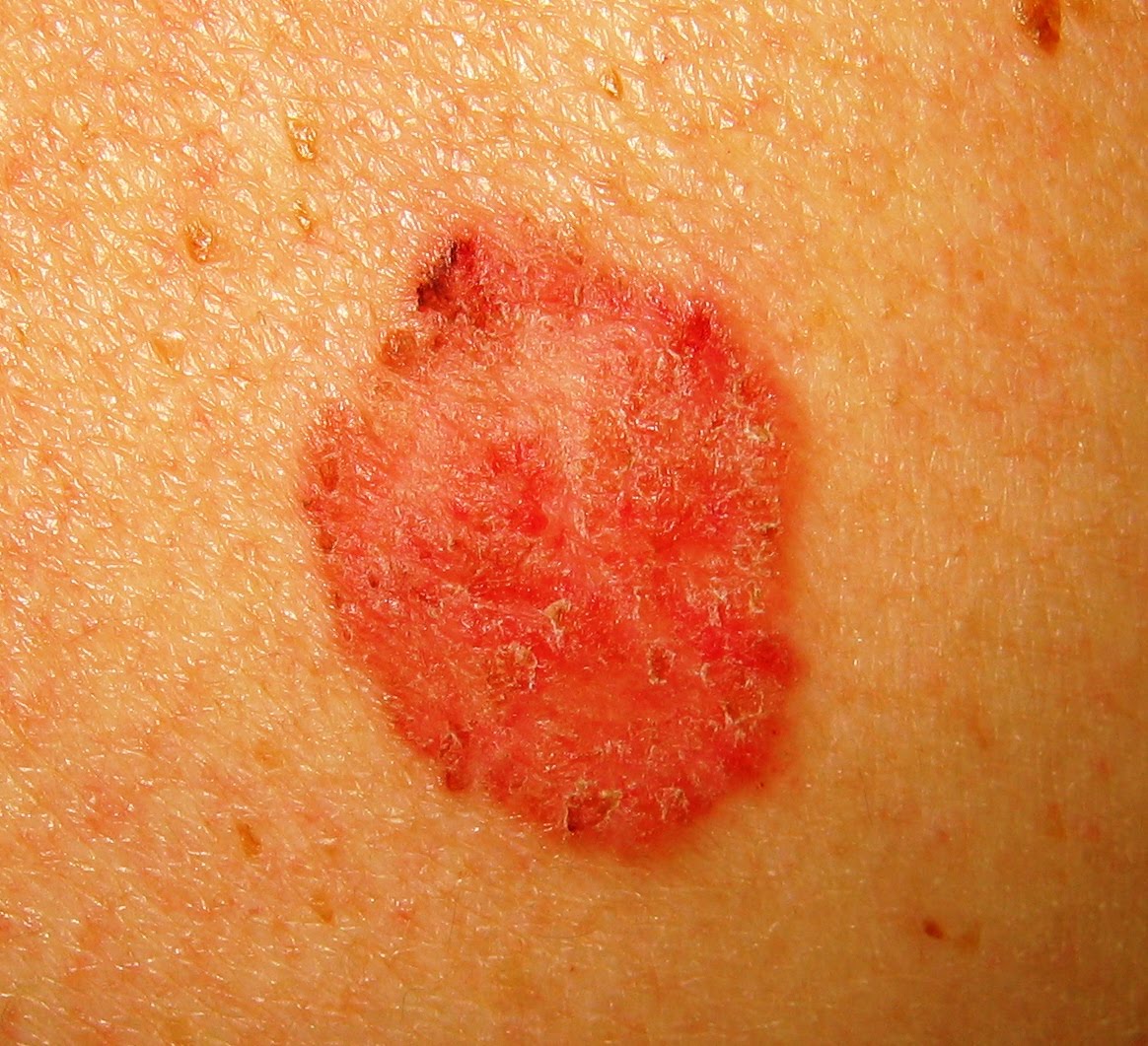 Red Raised Blood Spots On Skin