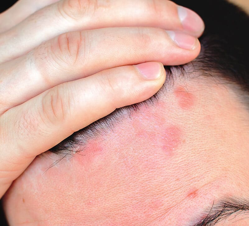 Red spots on scalp: Pictures, causes, and treatments