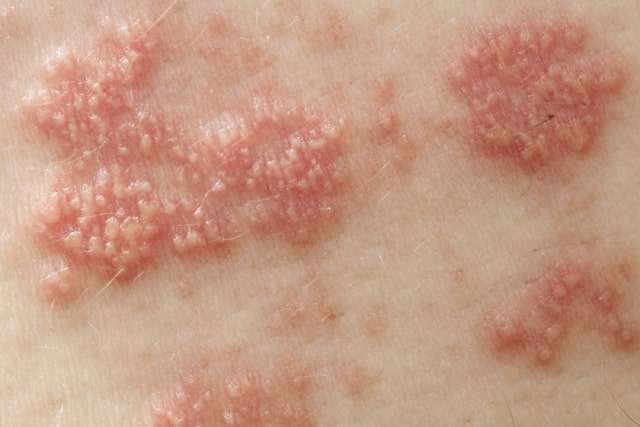 Red Spots on Skin, Itchy, Small, Pictures, Causes &  Treatment